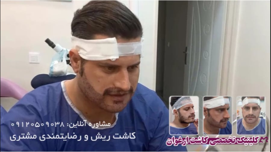 بازاریابی کلینیک کاشت مو 19 نمونه کاشت ریش