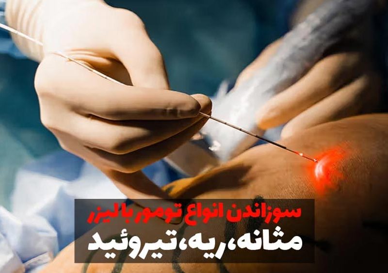 سوزاندن تومور با لیزر