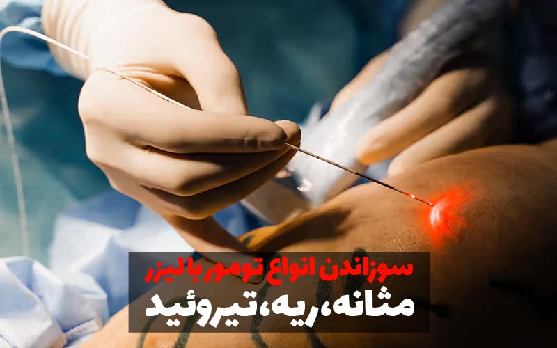 سوزاندن تومور با لیزر 11 سوزاندن تومور با لیزر